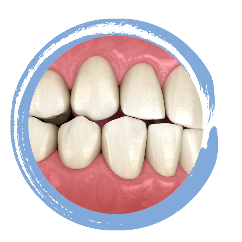 Occlusal unevenv 3dmodel