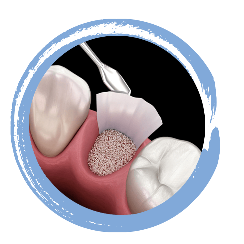 grafting 3d model