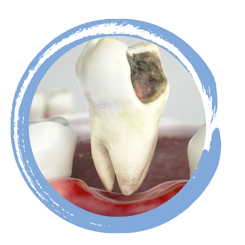 tooth extraction 3d model